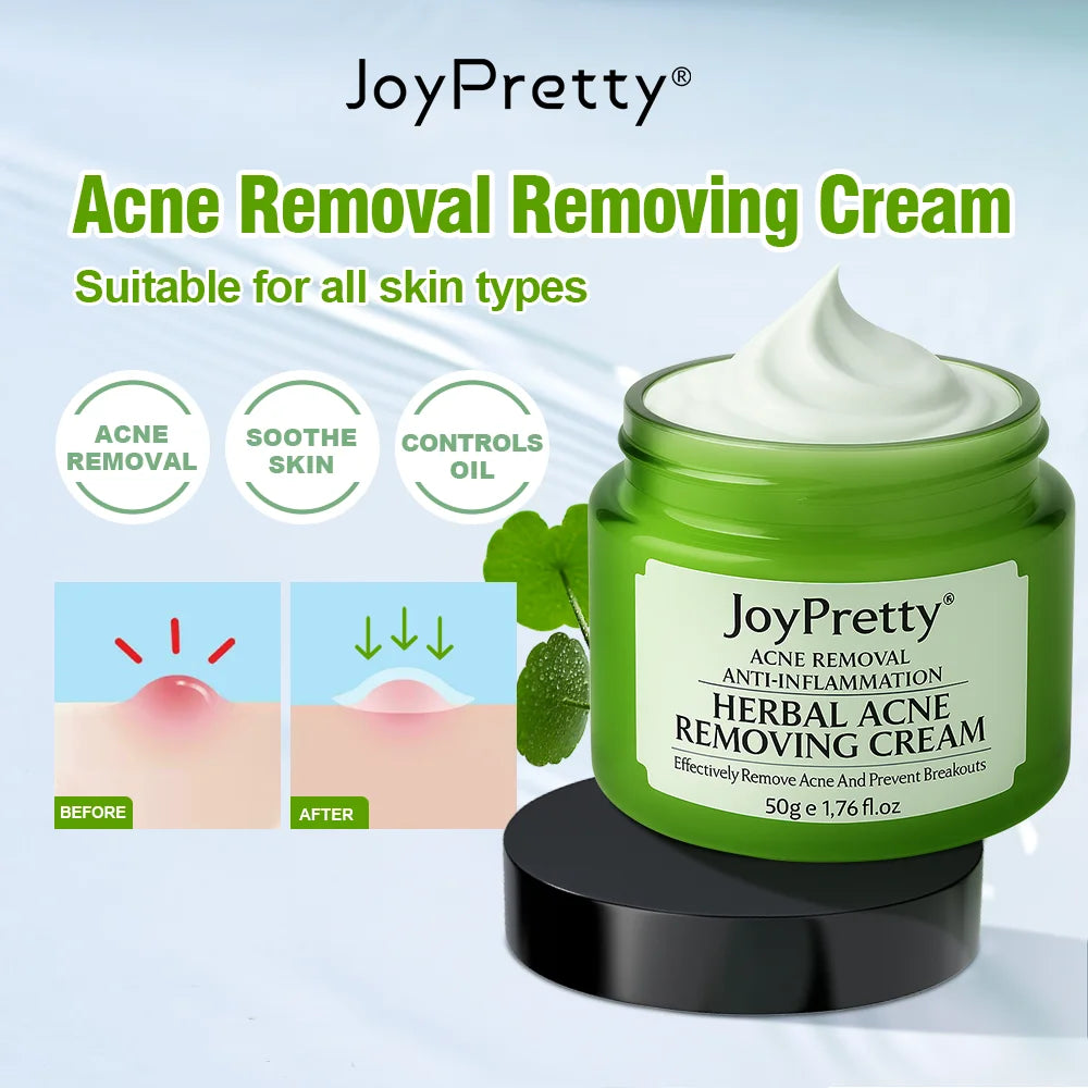 Acne Control Face Cream