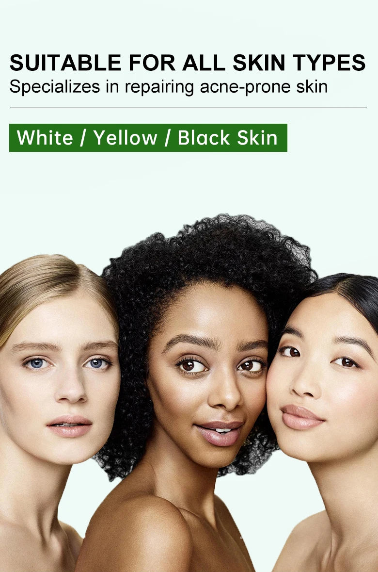 Acne Control Face Cream